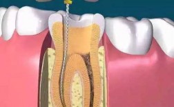 牙髓失活术的全过程（牙髓失活术的目的是什么）