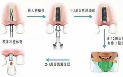 种植牙治疗过程（种植牙治疗过程视频）