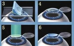 激光近视眼过程（激光近视怎么手术的）