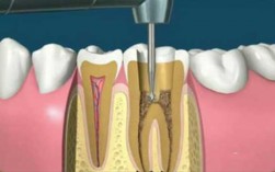 牙根填充过程（牙根填充是补牙吗）
