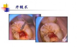 开髓过程（开髓的视频）