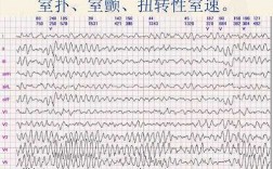 室颤死亡过程（室颤导致死亡的原因）