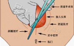 包含会阴侧切的过程的词条