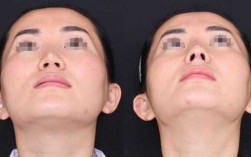 硅胶隆鼻过程（硅胶隆鼻过程图片）