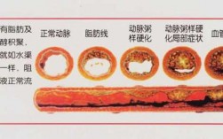 斑块形成过程（动脉粥样硬化斑块形成过程）