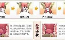 痔疮痊愈过程（痔疮的恢复期要多久）