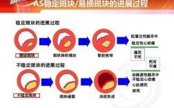 稳定斑块进展过程（稳定斑块的进展过程包括哪些）