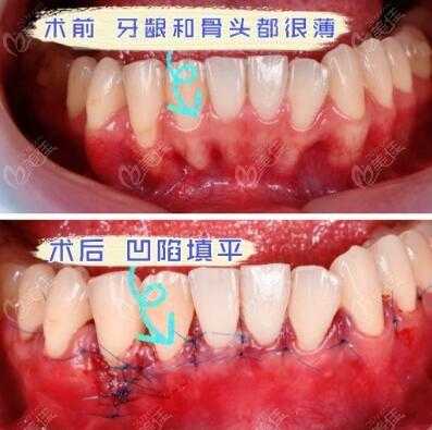 牙槽骨突出手术过程（牙槽骨突出手术需要多长时间）-图2