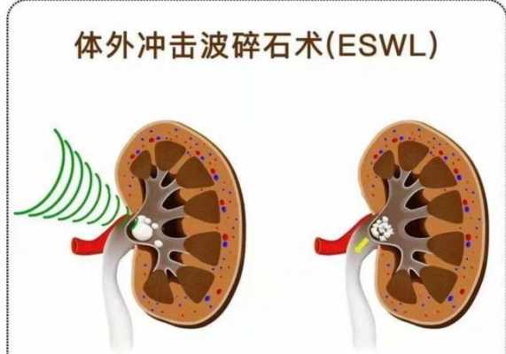 尿路结石排石过程（尿路结石排石治疗适应症）-图2