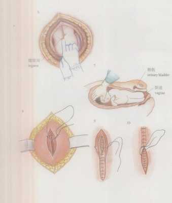剖宫产做过程（刨宫产过程）-图3