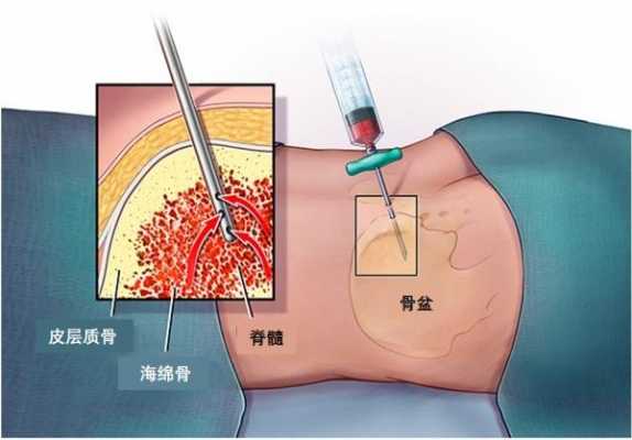 抽骨髓过程活检（抽骨髓过程活检要多久）-图1