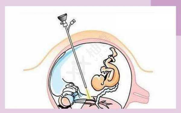 试管减胎术过程？（试管减胎术的过程）-图1