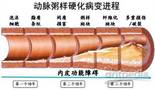 斑块形成过程（动脉粥样硬化斑块形成过程）-图2