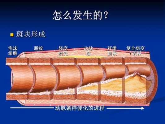 斑块形成过程（动脉粥样硬化斑块形成过程）-图3