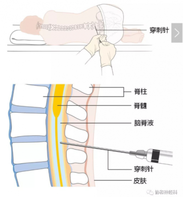 腰椎穿刺脑脊液过程（腰椎穿刺脑脊液检查操作步骤）-图2