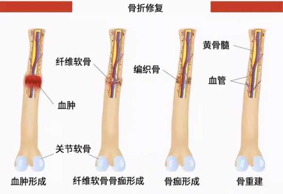 骨痂形成过程图片（骨痂形成过程视频）-图1