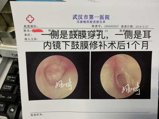 耳膜修复手术过程（耳膜修复手术过程图解）-图3