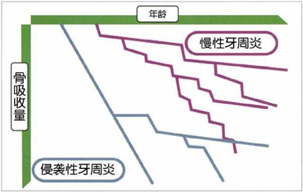 牙周病演变过程（牙周病的发病机制）-图3