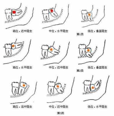 拔尽头牙过程图（拔尽头牙过程图解）-图1