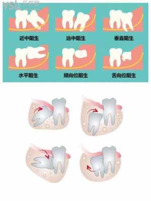 拔尽头牙过程图（拔尽头牙过程图解）-图3