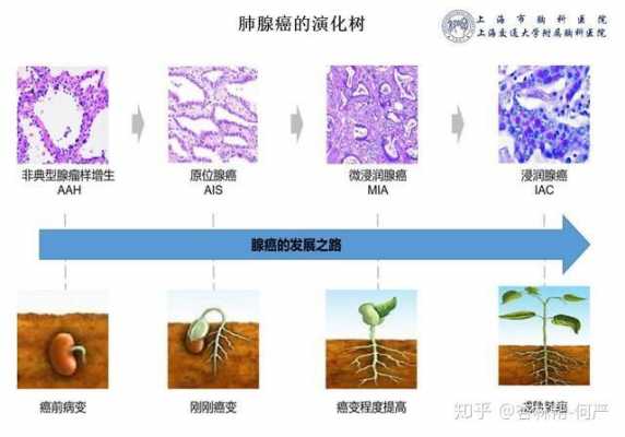 肺腺癌进化过程（肺腺癌的三个发展阶段过程）-图1