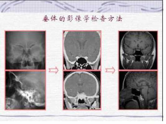 核磁共振检查过程（儿童垂体核磁共振检查过程）-图3