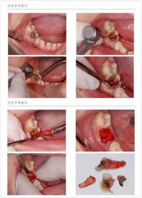 拔牙过程时间过长（拔牙过程时间过长怎么办）-图2