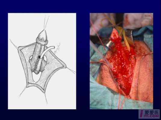 女变男的手术过程视频（女变男手术需要什么视频）-图2