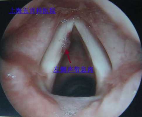 声带肿瘤手术过程（声带肿瘤术后还会复发吗）-图1