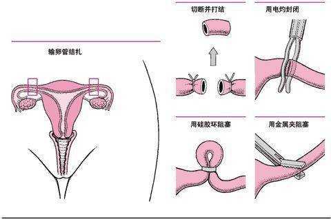 女人结扎全过程播放（女人结扎全过程播放视频）-图1