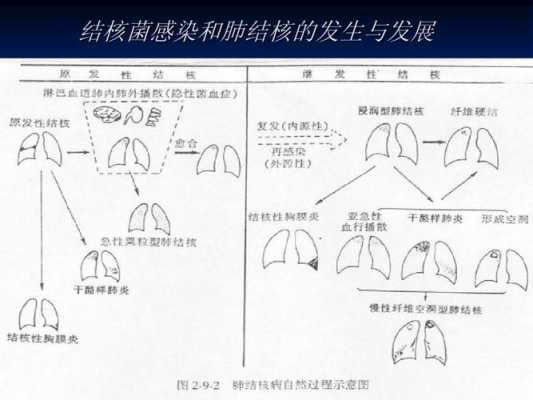 肺结核的发病过程（肺结核的发病过程是什么）-图3