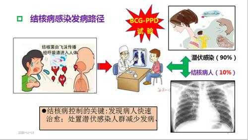 肺结核的发病过程（肺结核的发病过程是什么）-图1