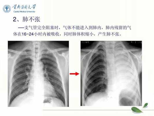 呼吸过程x光（x线摄影中呼吸方式的应用）-图2