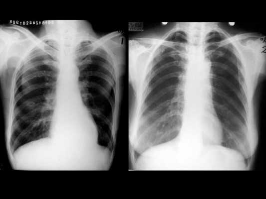 呼吸过程x光（x线摄影中呼吸方式的应用）-图3