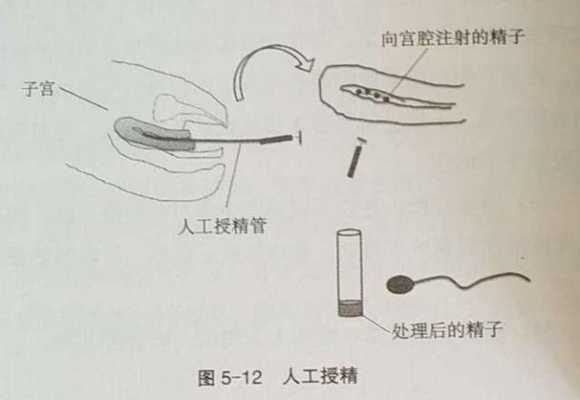 人工受精是怎么个过程（人工受精具体怎么操作）-图1