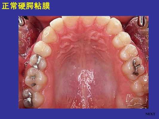 口腔粘膜恢复过程（口腔粘膜恢复过程图片）-图1