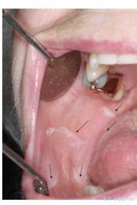口腔粘膜恢复过程（口腔粘膜恢复过程图片）-图3