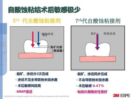 树脂充填护理过程（树脂充填技术要点）-图2