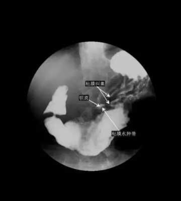胃造影过程（胃部造影过程）-图2