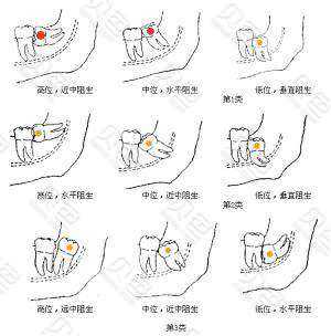 智齿成长过程（智齿成长过程中可以拔吗）-图3