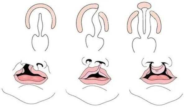 唇裂正畸过程（唇腭裂正畸治疗的风险）-图2