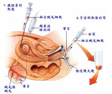 抽绒毛过程（绒毛抽取）-图2