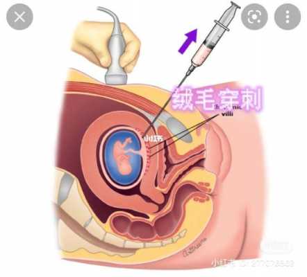 抽绒毛过程（绒毛抽取）-图1