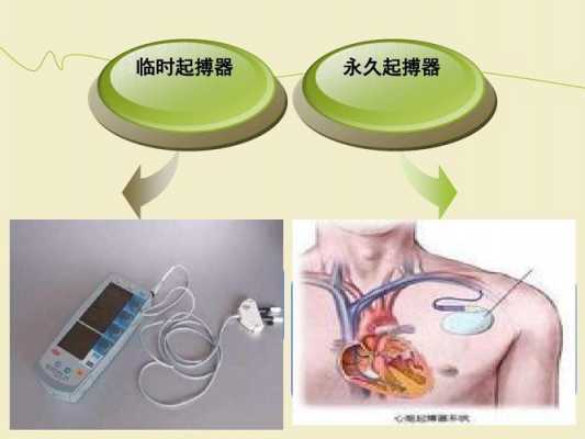 心脏起搏器植入过程（心脏起搏器植入过程视频）-图1