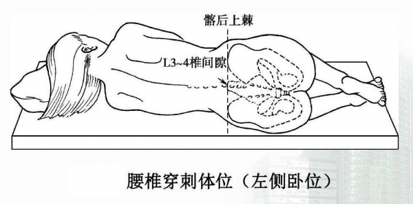 腰椎穿刺过程（腰椎穿刺过程要多久）-图3