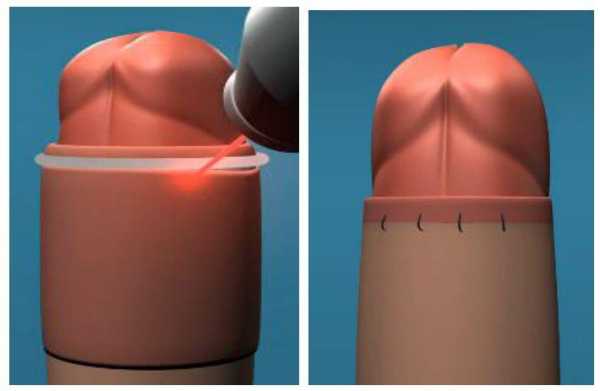 激光包茎手术过程（激光包茎手术得多长时间痊愈）-图1