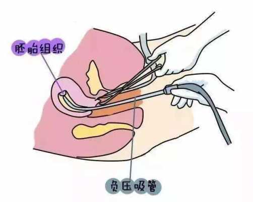 直视无痛人流过程的简单介绍-图3