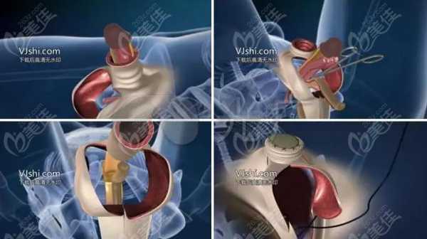 变性手术过程图解（变性手术过程图解视频）-图3