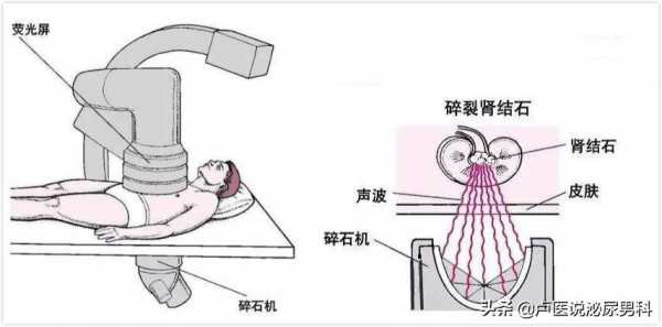 体外碎石的过程（体外碎石的过程和时间）-图1