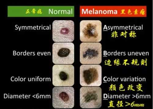 痣的癌变过程（痣的癌变过程图）-图1